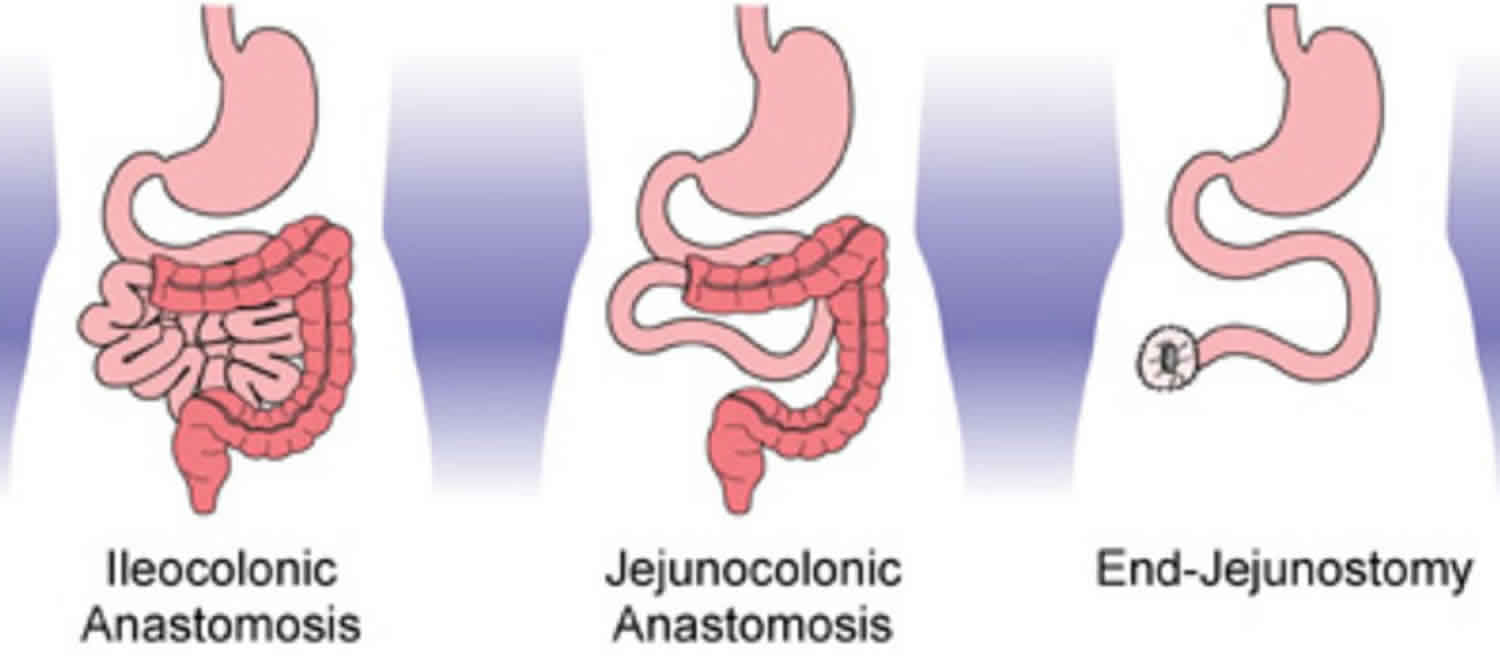 short-bowel-syndrome-causes-symptoms-diagnosis-treatment-prognosis