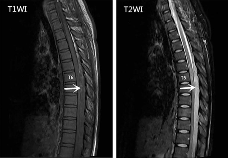 Epidural abscess causes, symptoms, diagnosis, treatment & prognosis