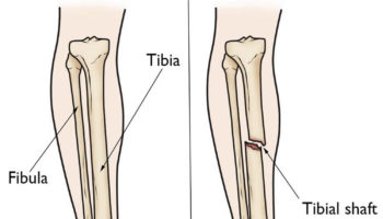 tibial shaft fracture