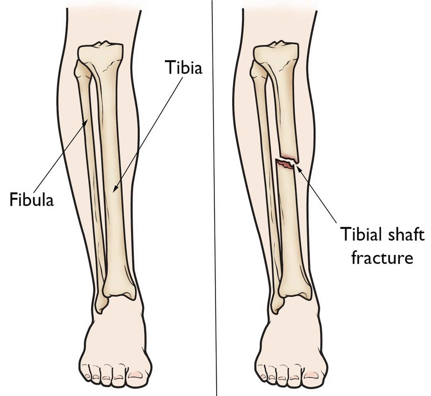 Tibial shaft fracture causes, types, symptoms, diagnosis, treatment