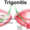 trigonitis