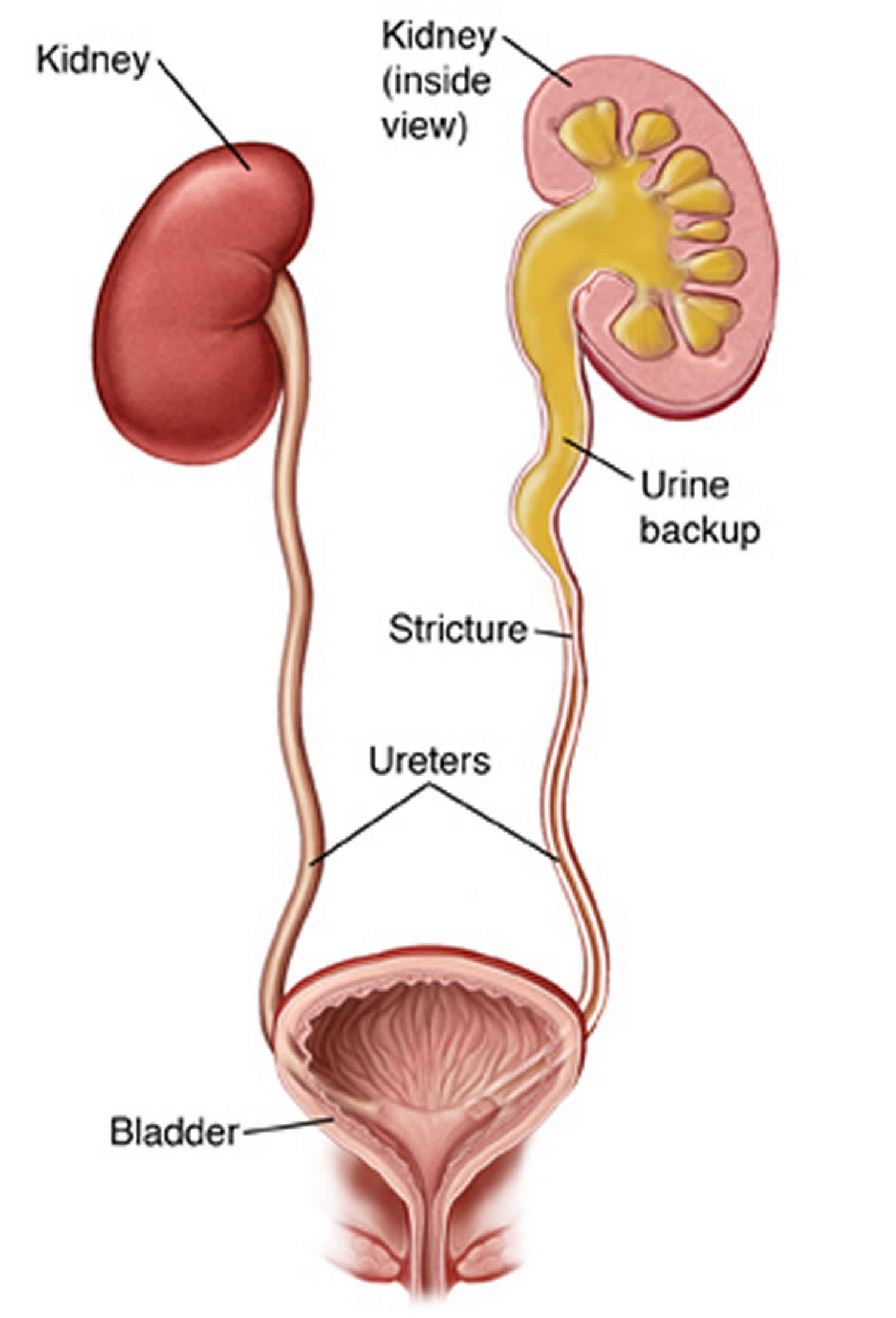 Normal Narrowing Of Ureter