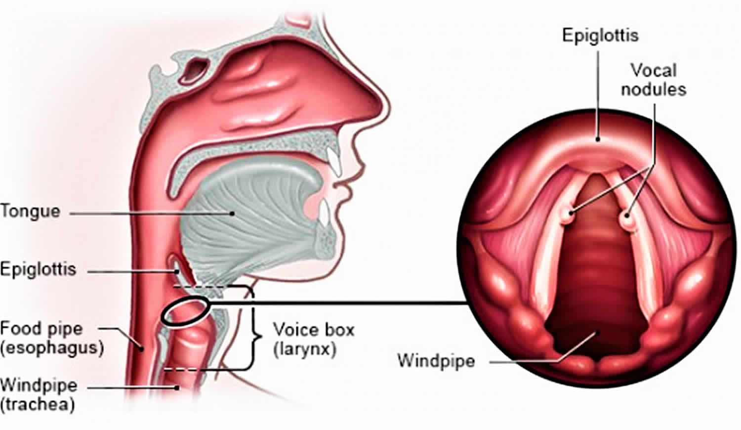 What Causes Tight Vocal Cords