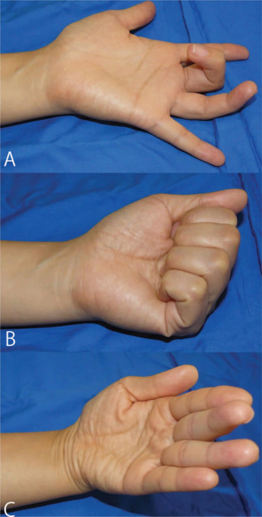 Volkmann's contracture causes, symptoms, diagnosis & treatment