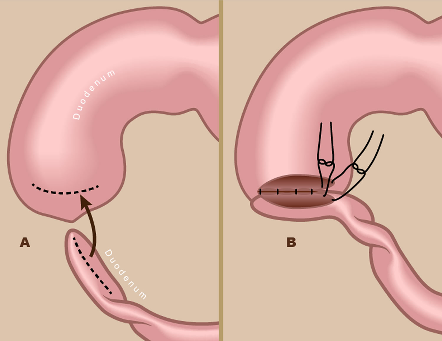Операция желудка кишечника. Стенозы и атрезии 12 перстной кишки. Атрезия двенадцатиперстной кишки операция.