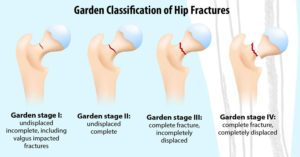 impacted subcapital fracture