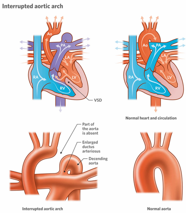 Interrupted aortic arch causes, types, symptoms, diagnosis, treatment ...