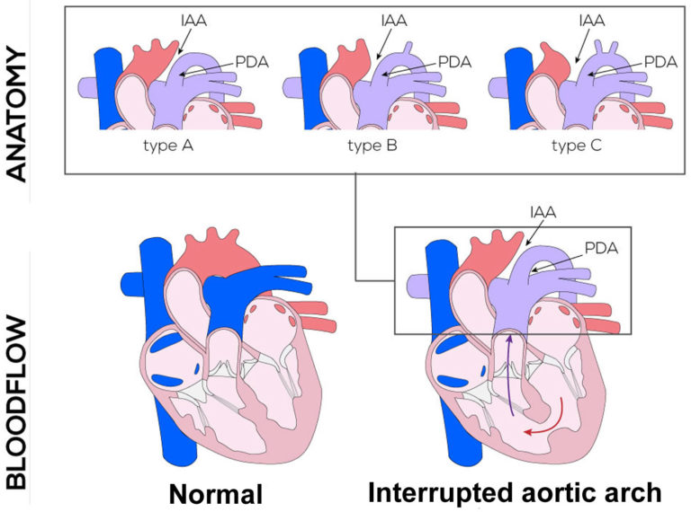 Interrupted aortic arch causes, types, symptoms, diagnosis, treatment ...