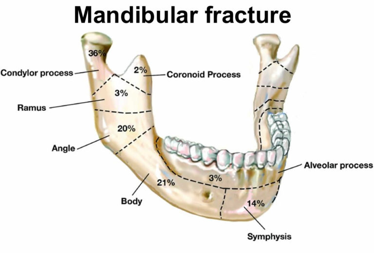 Facial Fractures Causes, Types, Symptoms, Diagnosis, Treatment & Recovery