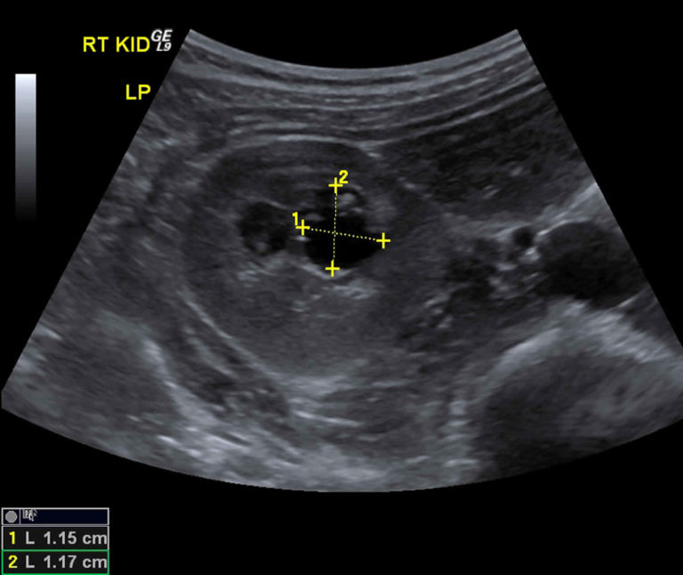 Medullary cystic kidney disease causes, symptoms, diagnosis & treatment