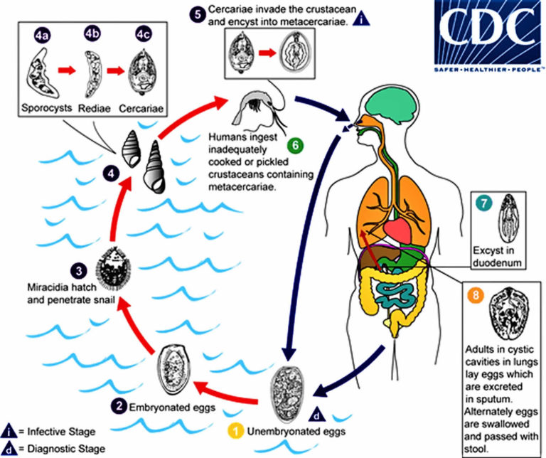 Paragonimiasis causes, symptoms, diagnosis & treatment