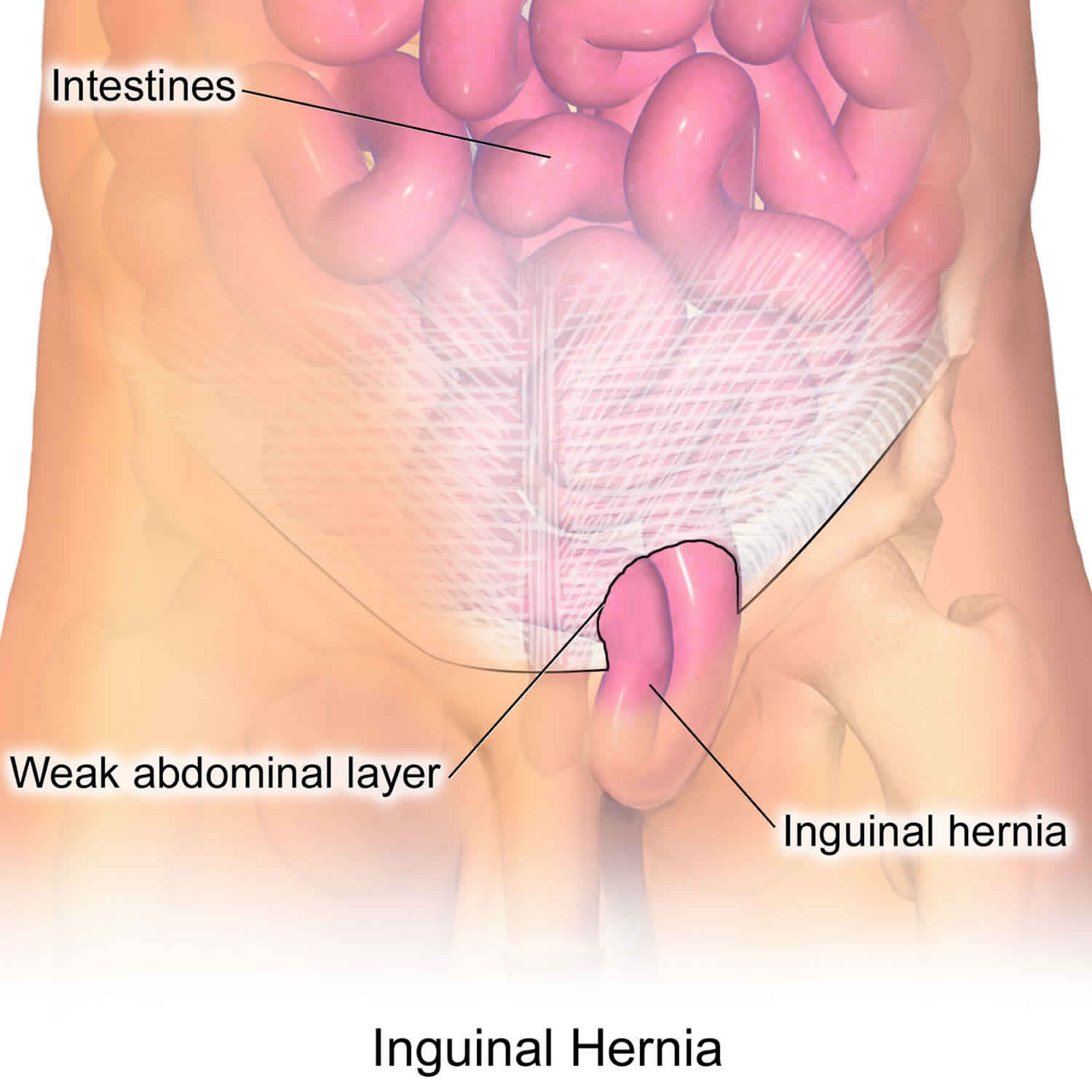 Pediatric inguinal hernia