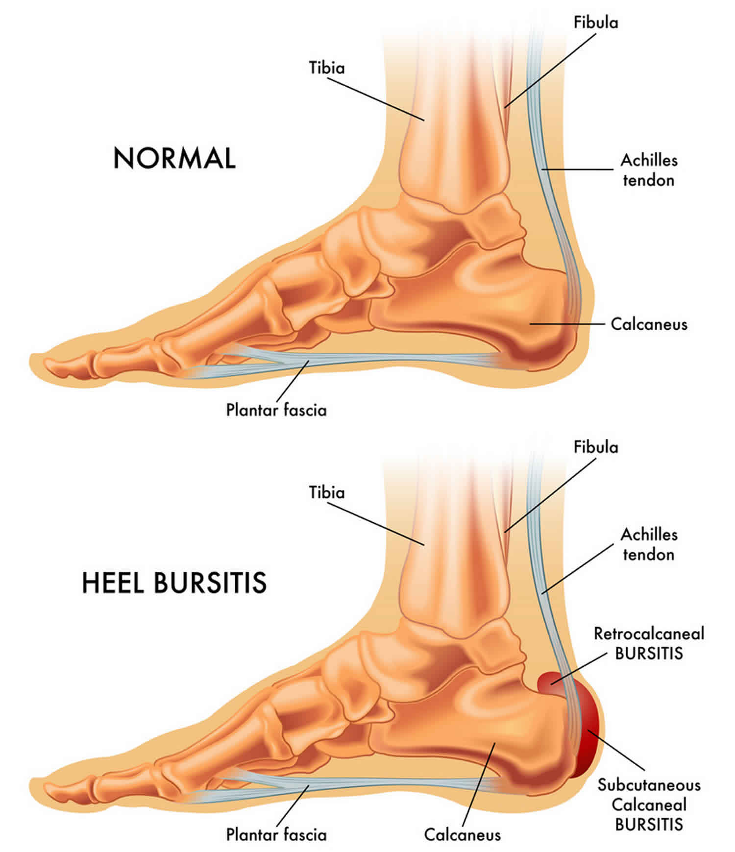 Retrocalcaneal Bursitis Causes Symptoms Diagnosis Treatment