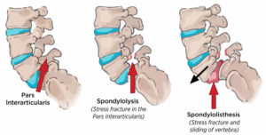 Spondylolysis causes, symptoms, diagnosis, treatment & prognosis