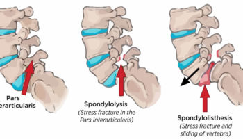 Spondylolysis