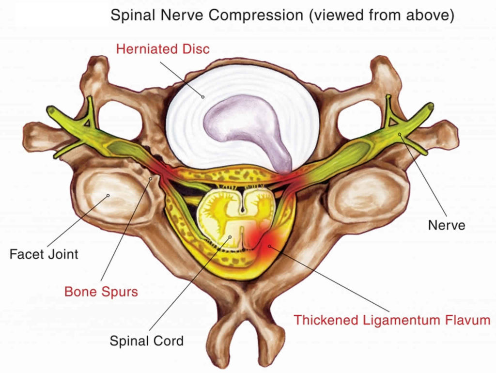 Thoracic Disc Herniation Causes Symptoms Diagnosis Treatment And Prognosis 