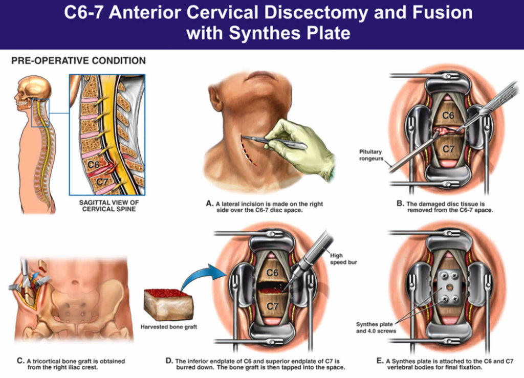 Cervical Radiculopathy Causes, Symptoms, Diagnosis & Treatment