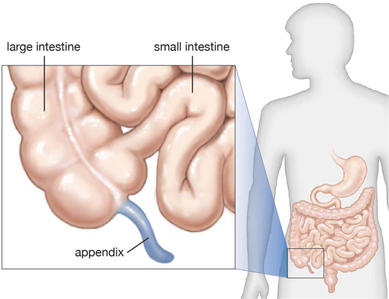 Pediatric appendicitis  causes symptoms diagnosis treatment