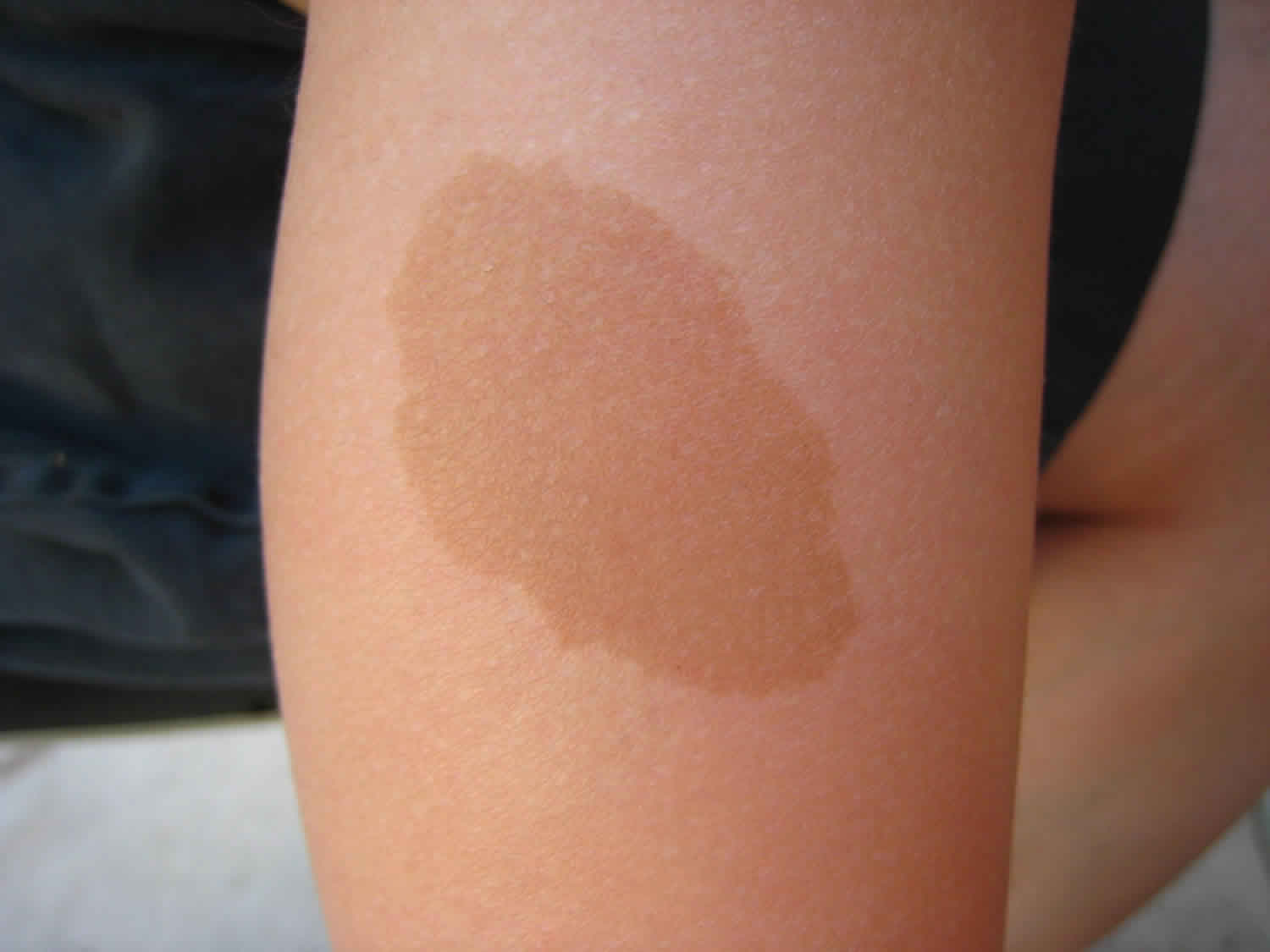 Cafe Au Lait Spots Causes Symptoms Diagnosis Treatment Prognosis