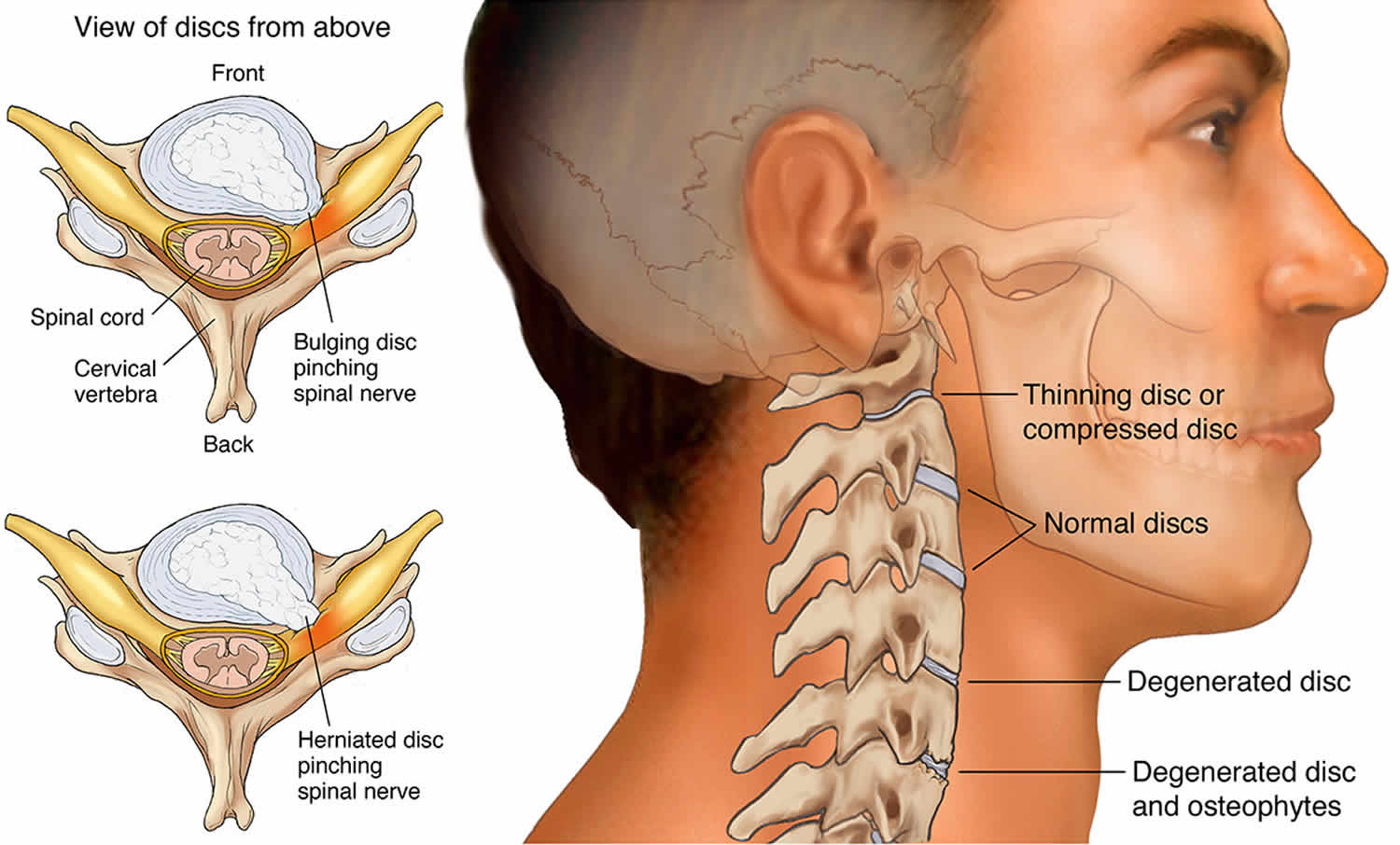 Cervical Radiculopathy Causes Symptoms Diagnosis Treatment