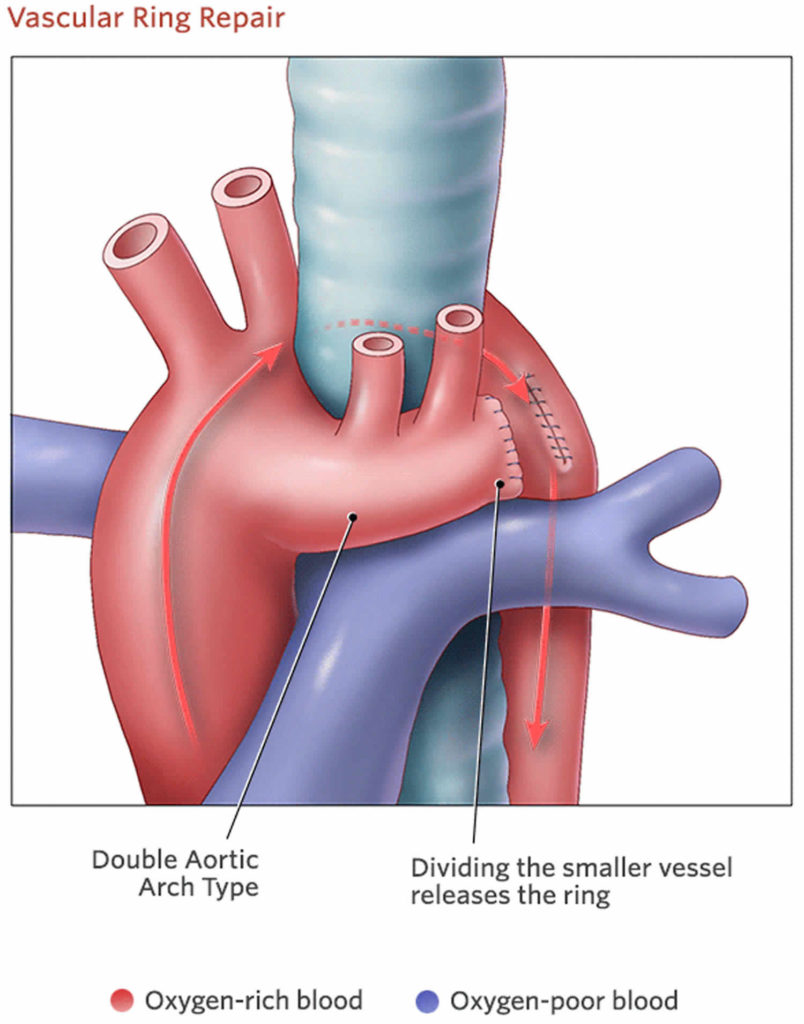 Double aortic arch causes, symptoms, diagnosis, treatment & prognosis