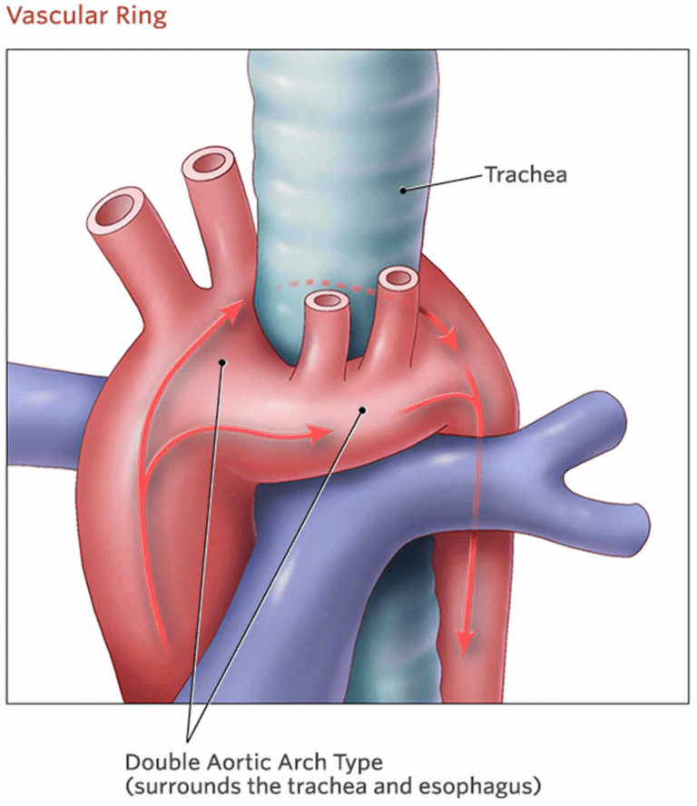 Double aortic arch causes, symptoms, diagnosis, treatment & prognosis