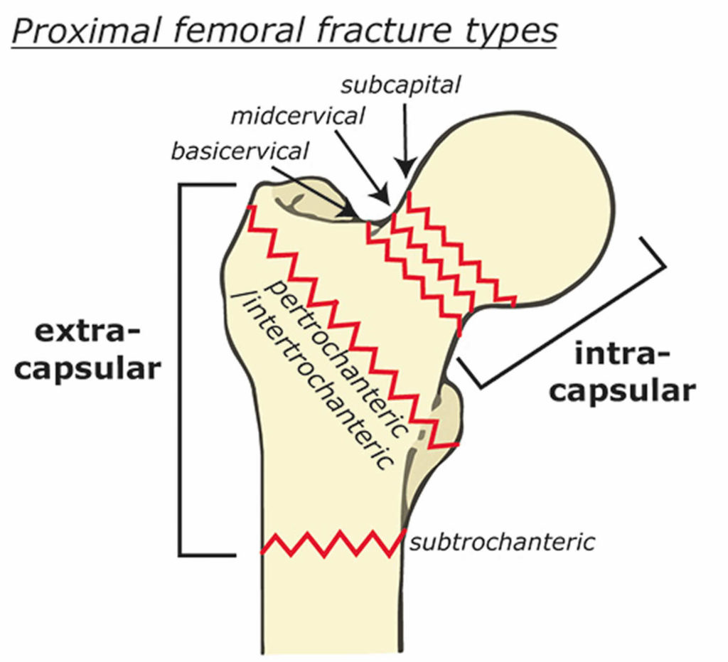 case study 3 1 displaced fracture of the femoral neck