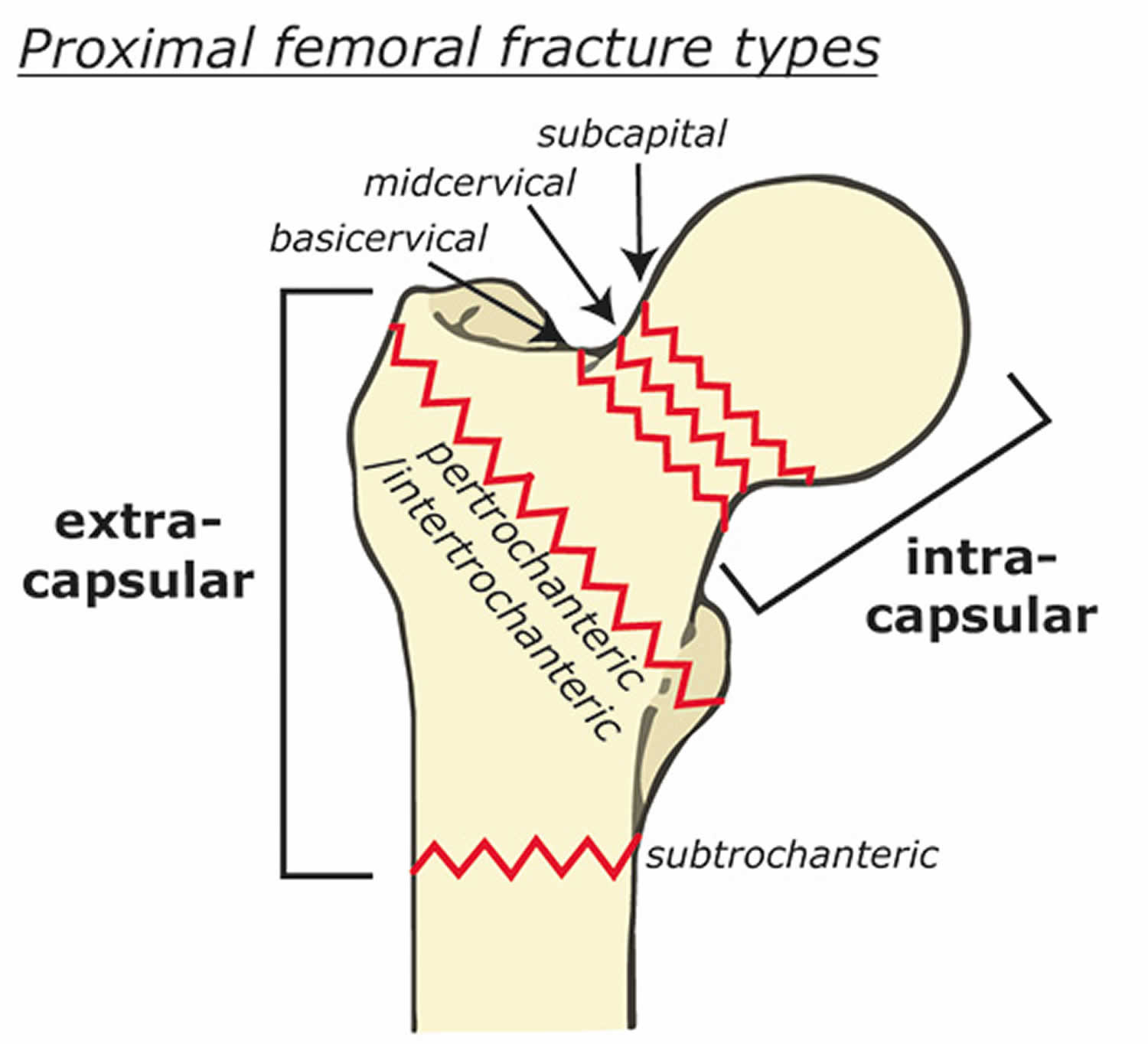 closed fracture of right femur icd 10