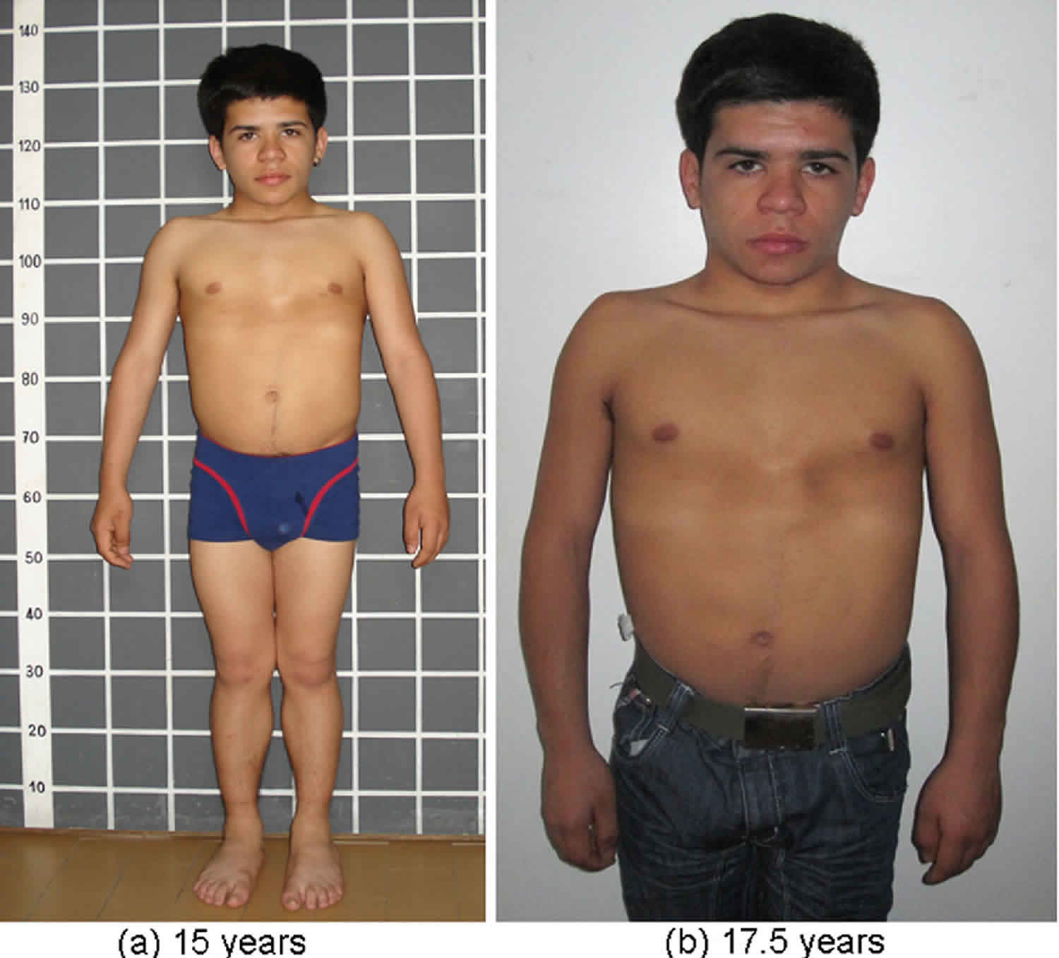 Growth hormone deficiency causes symptoms diagnosis treatment