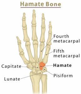 Hamate fracture causes, types, symptoms, diagnosis, treatment & prognosis