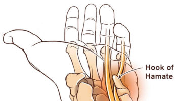 hamate fracture