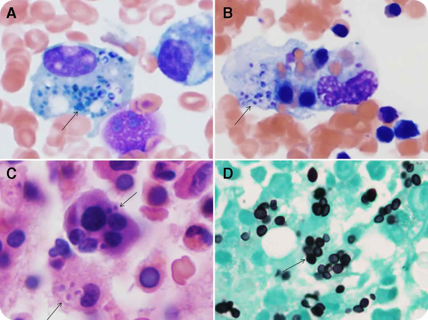 HLH Syndrome Causes Symptoms Diagnosis Treatment Prognosis