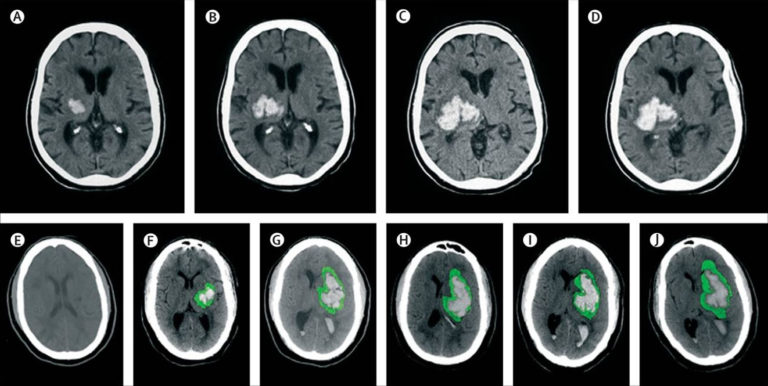 Intracerebral Hemorrhage Causes, Symptoms, Diagnosis, Treatment & Recovery