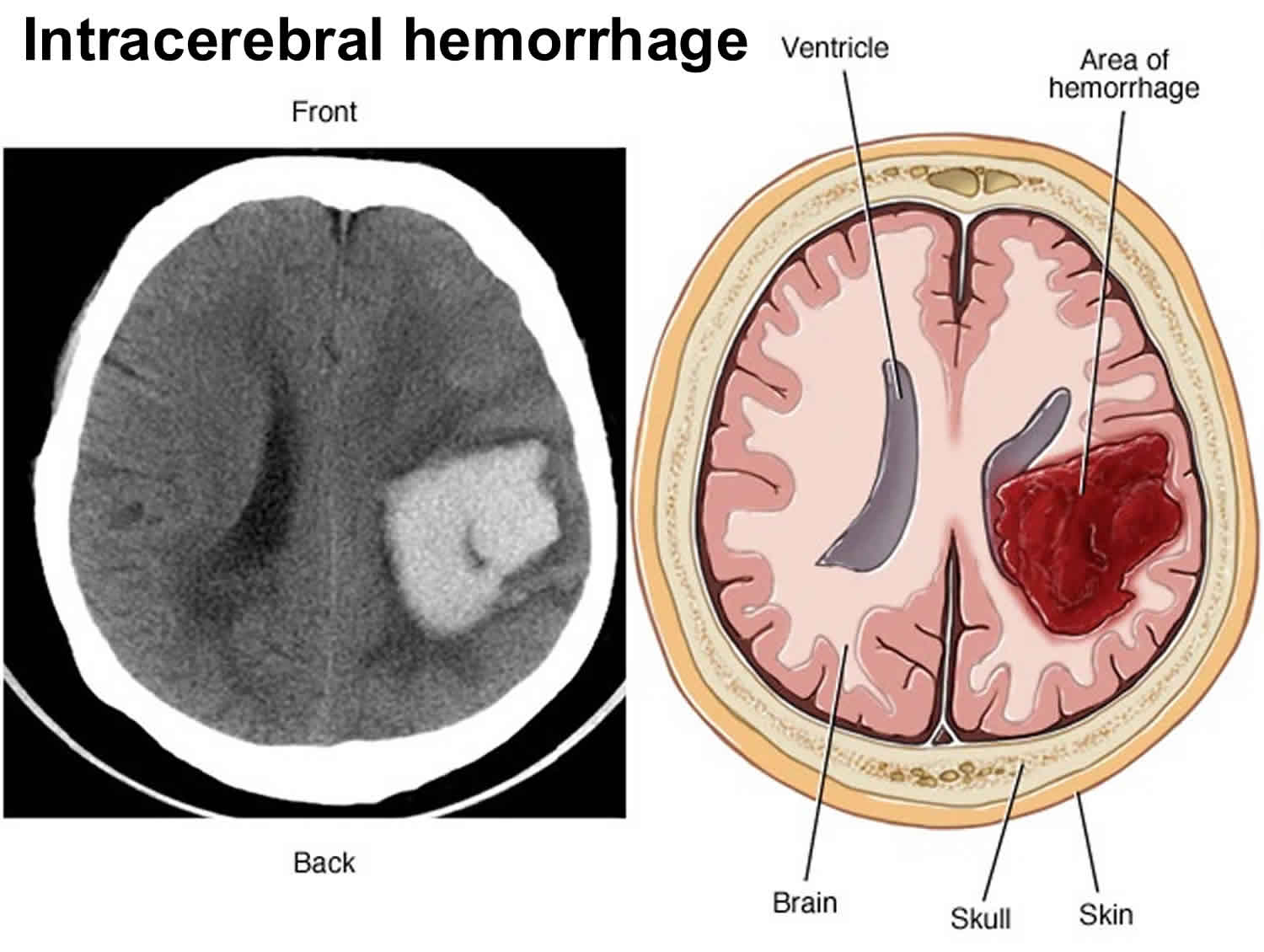 intraparenchymal hemorrhage vs subarachnoid hemorrhage