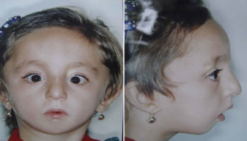 Nager acrofacial dysostosis
