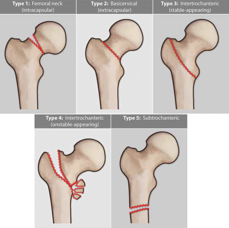 Femoral Neck Fracture Causes Types Symptoms Diagnosis Treatment