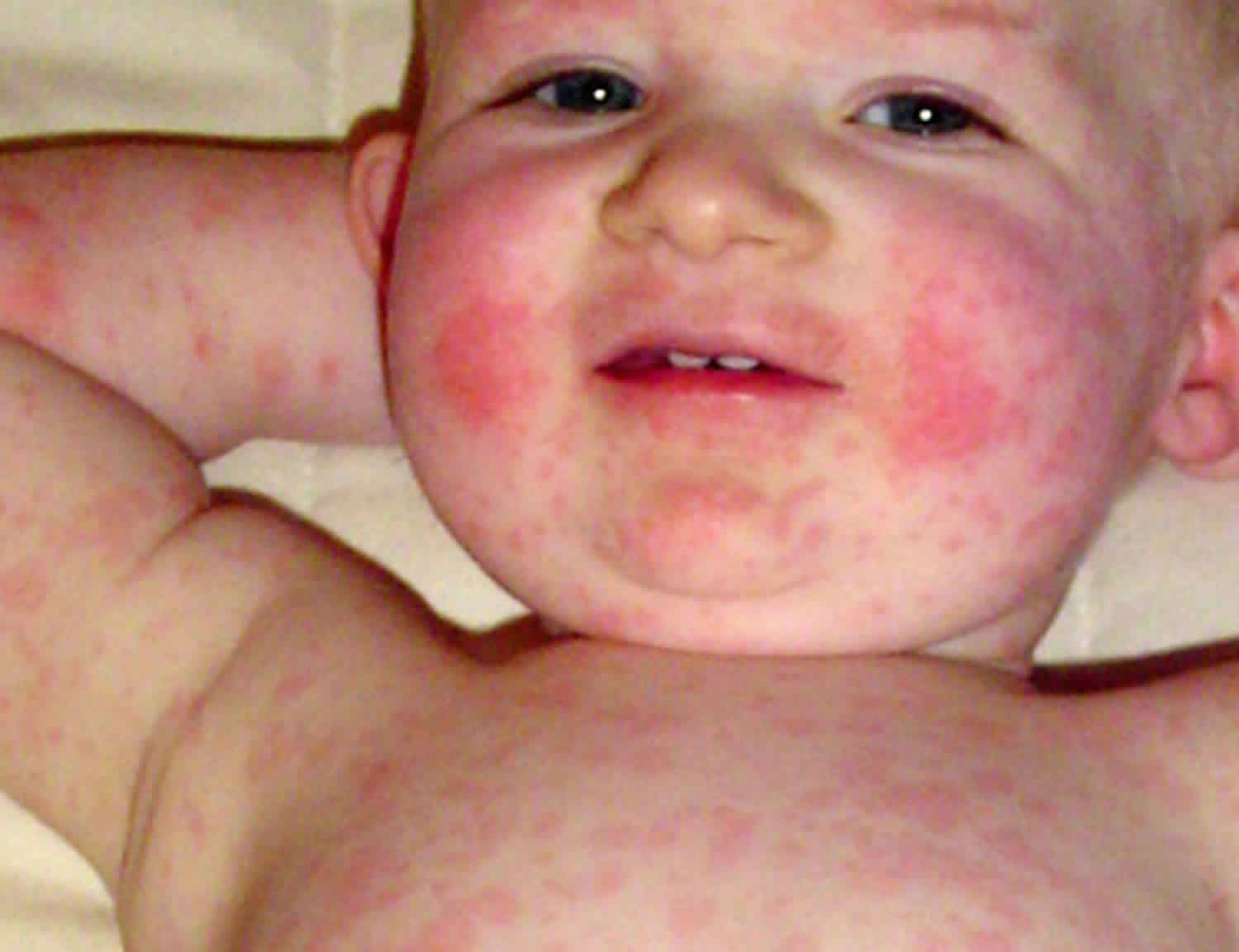 Parvovirus B19 Causes Symptoms Diagnosis Treatment Prognosis
