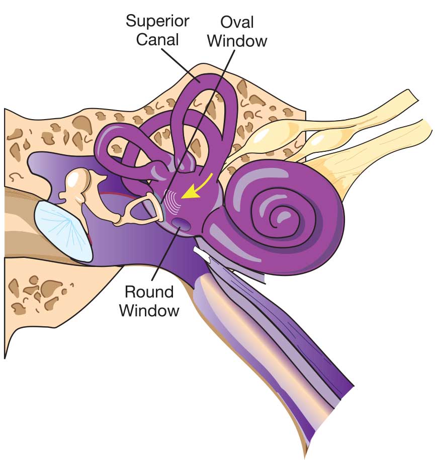 Perilymph fistula causes, symptoms, diagnosis, treatment & prognosis