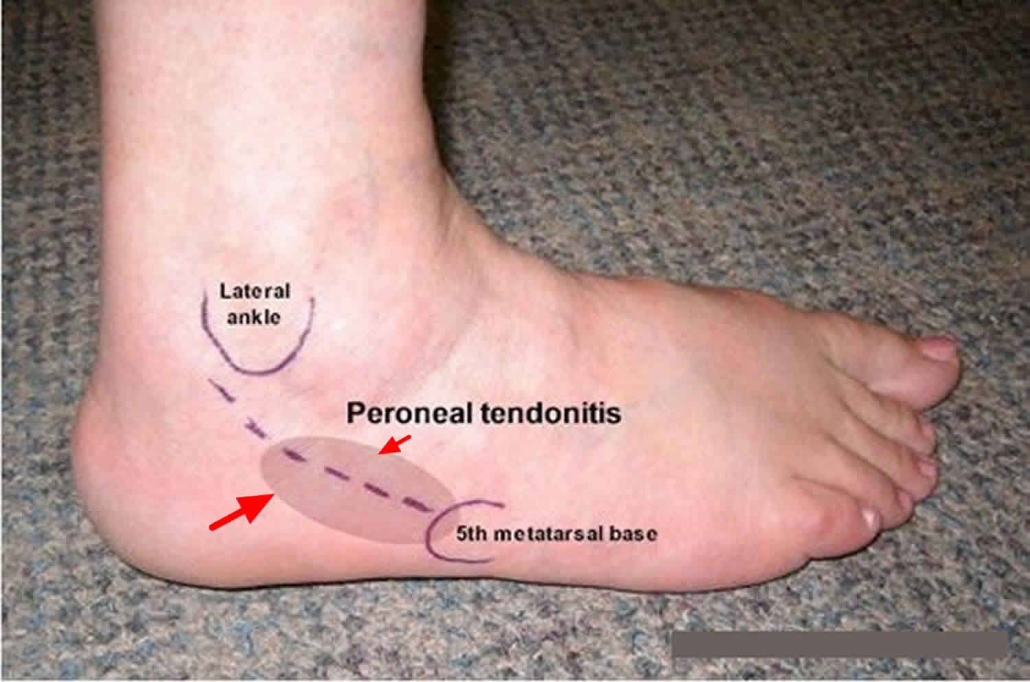 Peroneal Tendonitis Swelling
