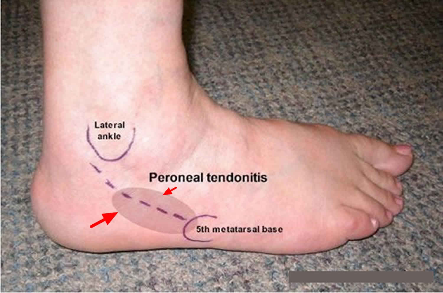 Peroneal tendonitis causes, symptoms 