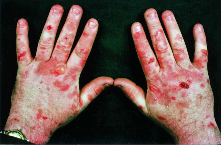 Porphyria cutaneous tarda causes, symptoms, diagnosis & treatment