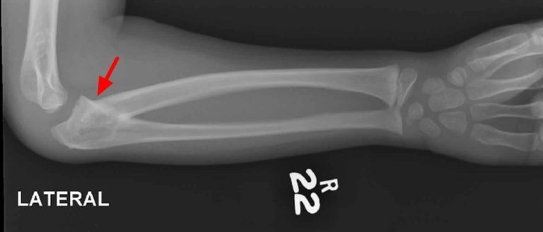 Radioulnar Synostosis Causes Symptoms Diagnosis Treatment And Prognosis 0562