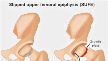 slipped capital femoral epiphysis