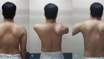 suprascapular neuropathy
