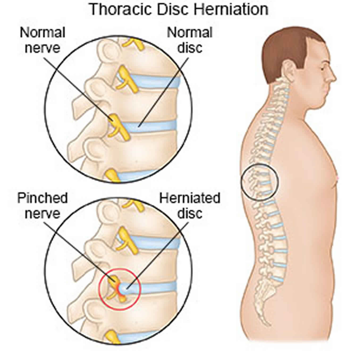 Thoracic Disc Bulge Treatment Captions Beautiful