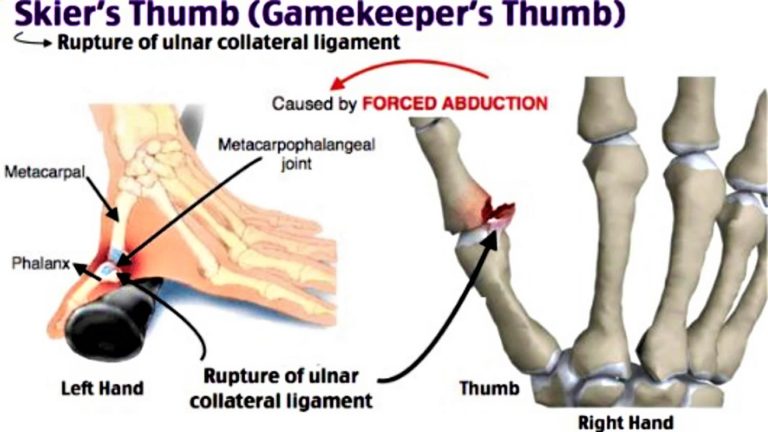 UCL injury causes, symptoms, diagnosis, treatment & prognosis