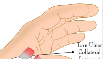 ulnar collateral ligament injury
