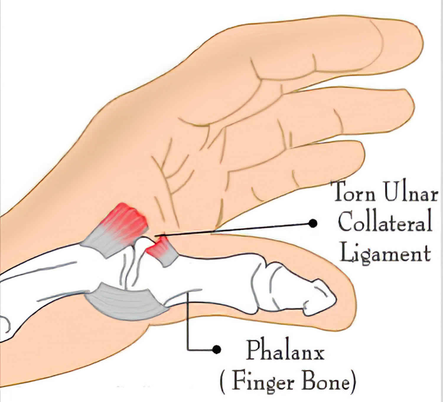 UCL injury causes, symptoms, diagnosis, treatment & prognosis