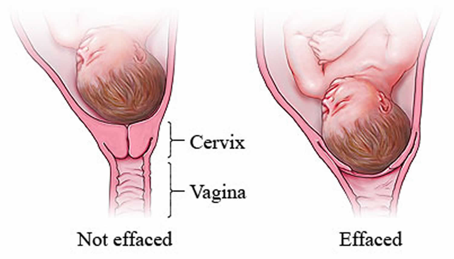 First stage: Thinning and opening of the cervix