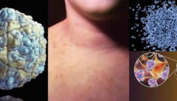 Echovirus